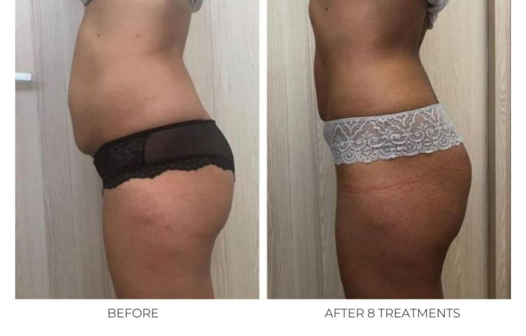 Before and after T Shape 2 Treatments