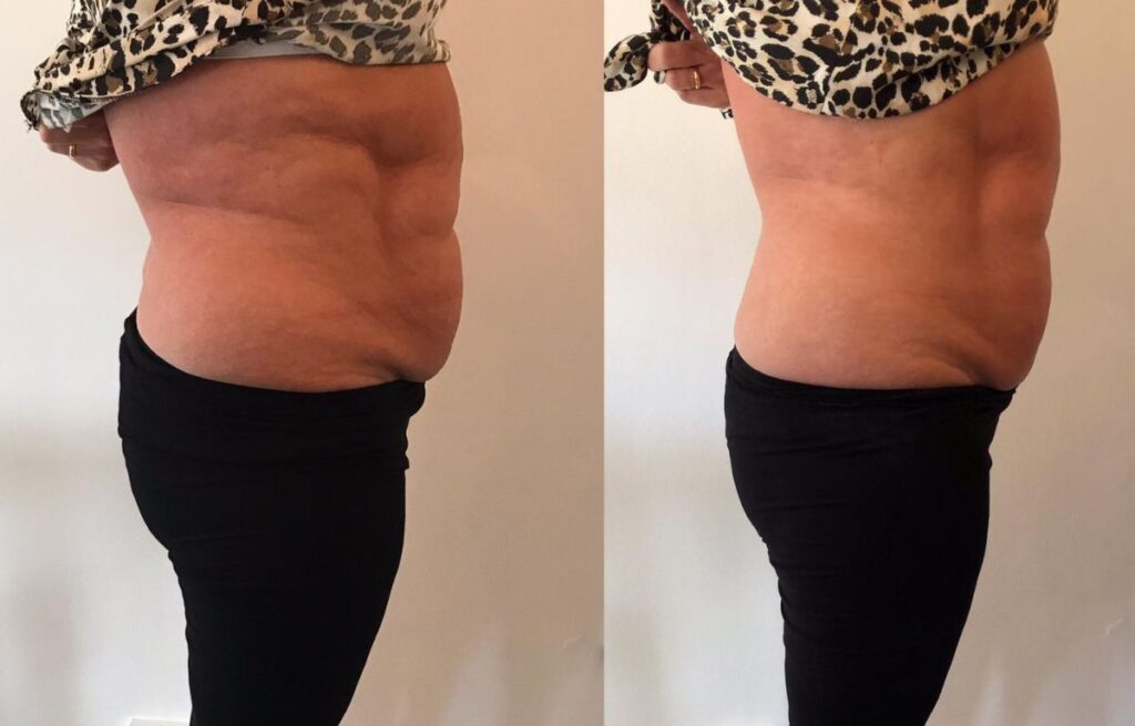 Before and after T Shape 2 Treatments